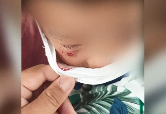 다트핀이 눈 밑에 박히는 사고를 당한 3살 아이는 봉합수술을 받았다. /SBS 뉴스 화면 캡처