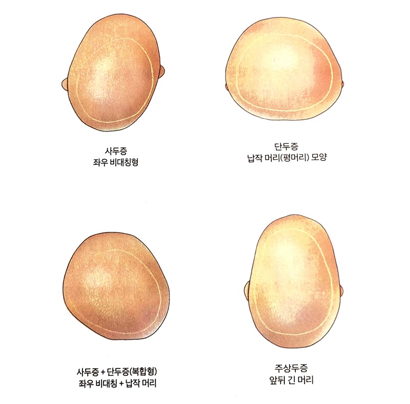 '머리모양이상'은 통상 △사두증 △단두증 △주상두증(또는 장두증)으로 구분한다. 사두증은 한쪽 뒤통수는 들어가고 반대쪽은 튀어나와 양쪽이 비대칭을 보이는 경우를 말한다. 단두증은 뒤통수가 납작한 형태, 주상두증은 머리 앞뒤가 긴 형태다. / 이미지=손근형 원장 제공