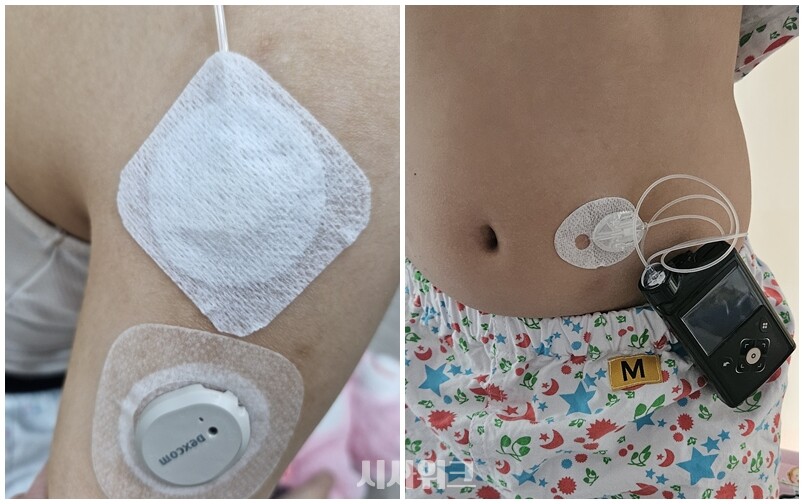 췌장장애가 있는 소아‧청소년은 피부에 센서를 부착해 혈당 수치를 지속적으로 확인할 수 있는 연속혈당측정기를 사용한다. 사진은 췌장장애 아동이 연속혈당측정기 센서를 몸에 부착한 모습이다. / 사진=이민지 기자